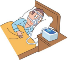 睡眠時無呼吸症候群 治療