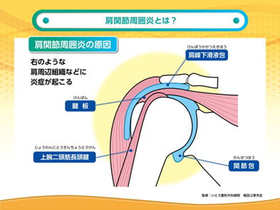 板倉病院 いたくらコラム 肩の痛み 肩関節周囲炎 について