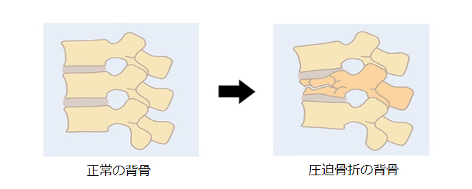 板倉病院 いたくらコラム 脊椎椎体骨折 圧迫骨折